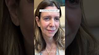 Patient Update 6 Months After Quadfecta Lift amp Endoscopic Brow Lift [upl. by Erodoeht]