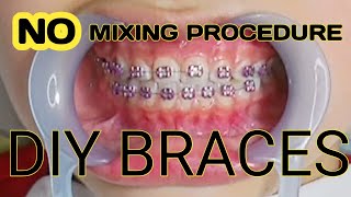 How To DIY Braces Part 2  No Mixing Procedure [upl. by Ajnin]