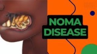 Understanding Noma Its Causes Symptoms and Treatment  A Comprehensive Health Education Guide [upl. by Elihu]