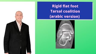 Rigid flat foot  Tarsal coalition arabic version [upl. by Lisetta]