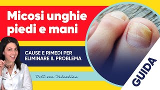 Micosi unghie piedi e mani le cause e i rimedi per eliminare il problema [upl. by Ailina]