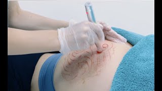 Stretch Mark removal using Microneedling [upl. by Robet]