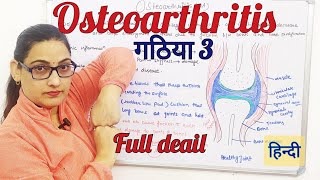 Osteoarthritis overview pathophysiology Cause SymptomsRisk Factors and Complications hindi [upl. by Anaig]