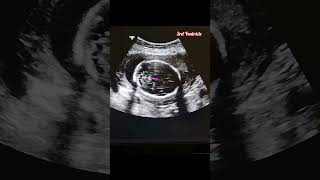 Fetal Biometry Series 1  Measuring the Biparietal Diameter pregnancy ultrasound [upl. by Anyat856]