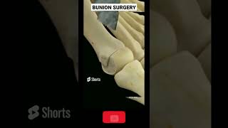 BUNION bunion treatment buniontoe bunion [upl. by Mckenzie]