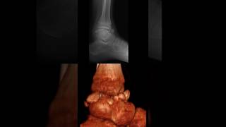 multiple intraarticular epiphyseal osteochondromas in the tibiotalar joint [upl. by Andromache]