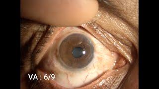 Therapeutic Keratoplasty Step by Step [upl. by Norrabal]