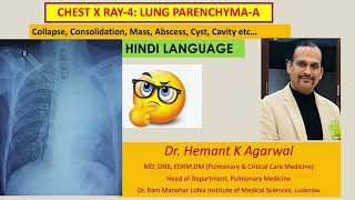 Radiology Chest X Ray4 HINDI Collapse Consolidation Mass AbscessDr Hemant K Agarwal [upl. by Enylorac]