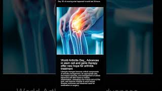 World Arthritis Day Advances in stem cell and gene therapy offer new hope for arthritis treatment [upl. by Bred221]