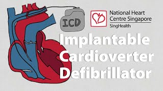 What is an Implantable CardioverterDefibrillator ICD  What to Expect [upl. by Madelina]