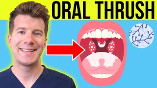 Doctor explains ORAL THRUSH Oral Candidiasis  Symptoms treatment amp prevention in adultsbabies [upl. by Solnit]