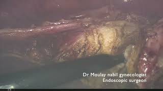 Subtotal hysterectomy in morbid obese patient [upl. by Abixah]