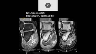 MRI of the Ankle Part 12 – Ankle Impingement [upl. by Elehcar]