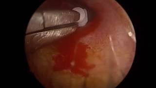 Grommet insertion for glue ear in right ear endoscopic [upl. by Alyak89]