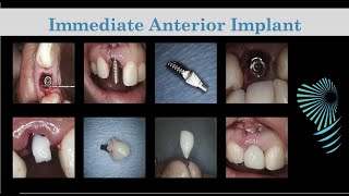 Immediate Anterior Implant  Temp Crown Fabrication  Step by Step [upl. by Illona]