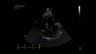 pulmonary stenosis [upl. by Inol]