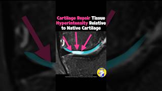Fig 5C09 MRI Findings of Autologous Chondrocyte Implantation [upl. by Prebo]