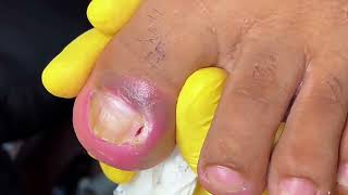 Shocking Ingrown Toenail Removal  satisfying ingrownhairremoval [upl. by Yk]