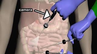 Laparoscopic Appendectomy  Animation by Cal Shipley MD [upl. by Lalaj]