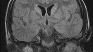 CNS C8 Limbic encephalitis B [upl. by Gagne653]