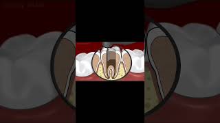 dental decay restoration animationasmr asmranimation asmrvideo animation stopmotionanimation [upl. by Reggi859]