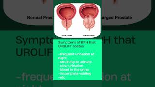 UroLift New in Health amp Technology for Prostate  Dr Himesh Gandhi [upl. by Philipa355]