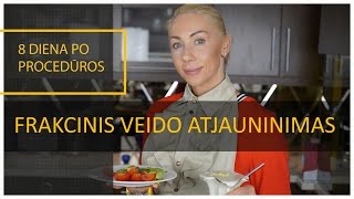 Frakcinis veido atjauninimas  Odos atjauninimas [upl. by Atteuqehs237]