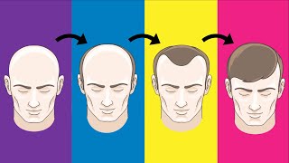 Top 5 Hair Loss Solutions That Actually Work [upl. by Abbey775]