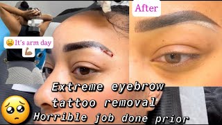 Microblading procedure with Saline Removal process mircoblading tattooremoval eyebrows [upl. by Sadonia]