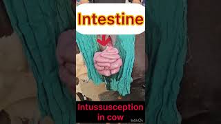 Intussusception l Intestine l dr Umar khan [upl. by Antonina]