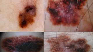 DERMATOSCOPIA DEL MELANOMA EXTENSIVO  Dra Virginia Gonzalez [upl. by Yleek]