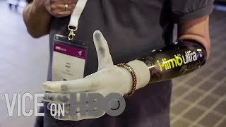 How Bionic Limbs Are Changing Lives [upl. by Zoellick]