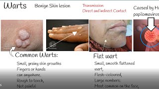 Warts causes and treatment Wart Types [upl. by Ahsinal]