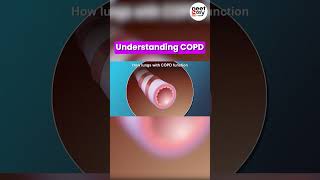 COPD  Chronic Obstructive Pulmonary Disease 🫁🫁 copd respiratorydisease neet [upl. by Odlareg91]