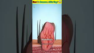 How🤔To Remove A Skin Tag 😨🤯 shorts [upl. by Hultgren]