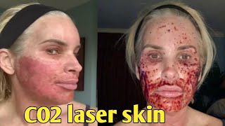 7Day Journey My CO2 Laser Skin Resurfacing Experience – Before and after chris link [upl. by Wershba]