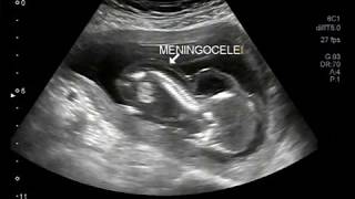 Ultrasound Video showing intrauterine death of fetus with encephalocele and meningocele [upl. by Isnan693]