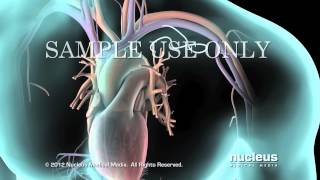 Desfibrilador cardioversor implantable ICD [upl. by Ynahpets]