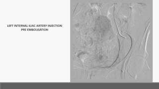 Preoperative sacral tumor embolisation [upl. by Maidel]