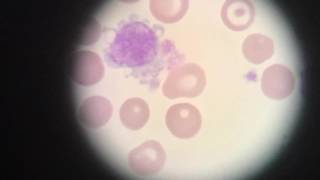 My Hematology Video  Sickle Cell Anemia [upl. by Nagorb]