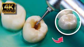 IMPRESIONANTE restauración dental en 4K [upl. by Locin133]