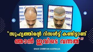 Best hair transplant clinic in kerala  hair transplant malayalam  la densitae kerala [upl. by Eetsud]