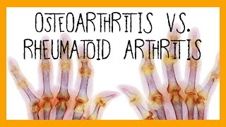 Osteoarthritis vs Rheumatoid Arthritis [upl. by Aruol]