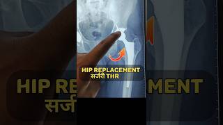 How Hip Joint Replaced कूल्हा बदल गया hipreplacementrecovery hipfracture hippain bone [upl. by Asertal]