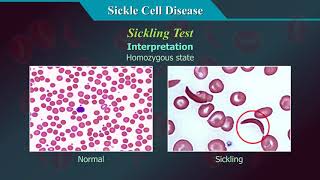 Sickle Cell Disease [upl. by Dougald]