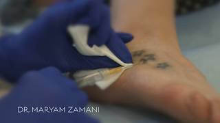 Plexr for Tattoo Removal  Dr Maryam Zamani [upl. by Nehgaem281]