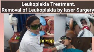 Leukoplakia TreatmentRemoval of Leukoplakia by laser Surgery [upl. by Enuahs372]