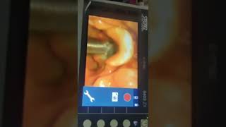 Nasotracheal Intubation Technique [upl. by Carrew]