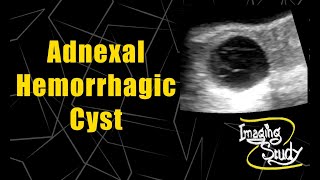 Adnexal Hemorrhagic Cyst  Ultrasound  Case 61 [upl. by Leirda865]