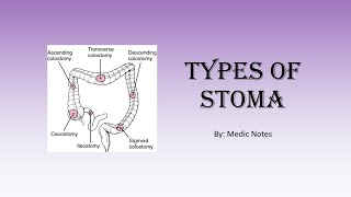 Types of stoma  colostomyileostomyurostomy endloopdoublebarrel temporarypermanent [upl. by Elfrieda]